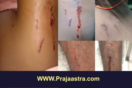 ಬಾಲಕಿ ಸೇರಿ ಐದಾರು ಜನರ ಮೇಲೆ ಬೀದಿ ನಾಯಿ ದಾಳಿ